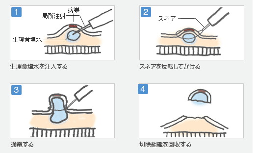 内視鏡的粘膜切除術-ＥＭＲ